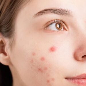 woman-with-acne