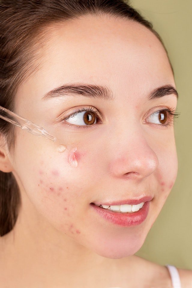 acne-caring